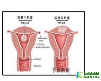 患子宫肌瘤可以怀孕吗