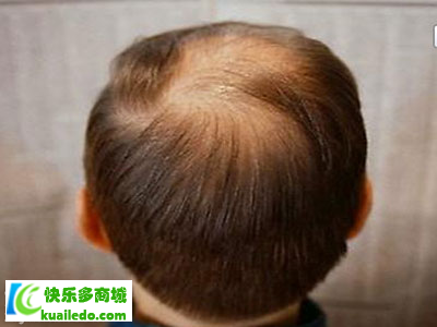 [解说]脂溢性脱发表现表现有哪些 详解脂溢性脱发的三大表现